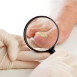 Is Toenail Fungus Contagious? Tips to Protect Your Feet