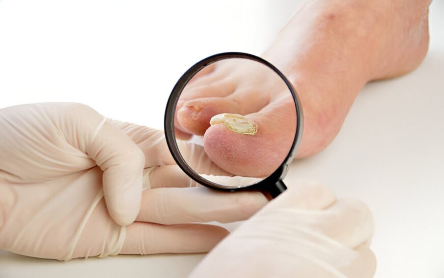 Is Toenail Fungus Contagious? Tips to Protect Your Feet