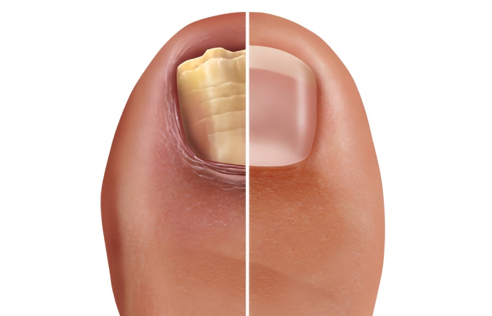 How Contagious Is Toenail Fungus?